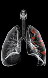 L'image de cancer du poumon
