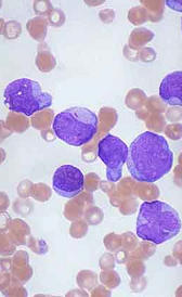 L'image de leucémie