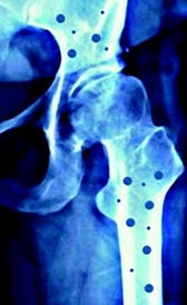 L'image de ostéoporose