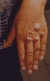 L'image de virus du papillome humain